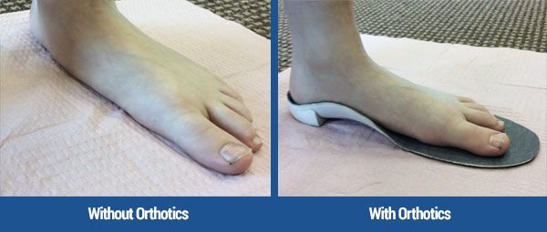 foot left, flat, with no support, then on right with an orthotic
